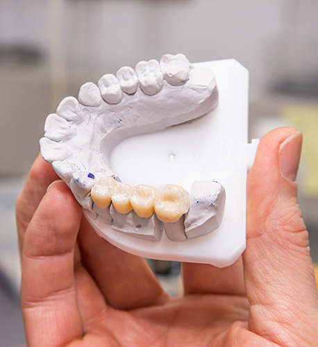 What Is a Dental Bridge from Santa Barbara Family Dentistry in Santa Maria Image.