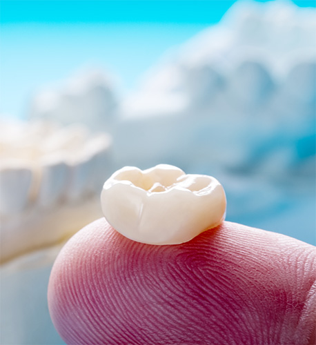 What Is a Dental Crown in Santa Maria Image.