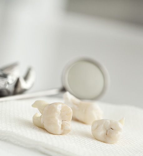 What Are Some Dental Extractions Reasons Santa Barbara Family Dentistry Image.