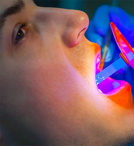 How Is Dental Decay Diagnosed at Santa Barbara Family Dentistry Image.