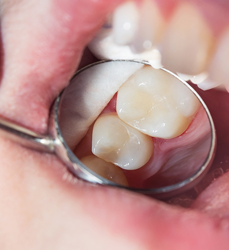 Why Do I Need a Filling from Santa Barbara Family Dentistry in Santa Maria Image.