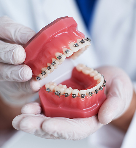 Traditional Metal Braces from Santa Barbara Family Dentistry Image.