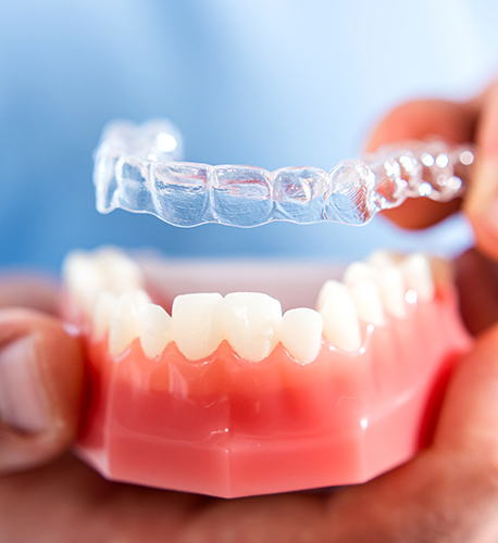 Invisalign® Clear Aligners in Santa Maria Image.