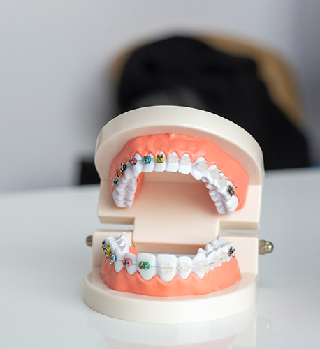 Porcelain Braces in Santa Maria Image.